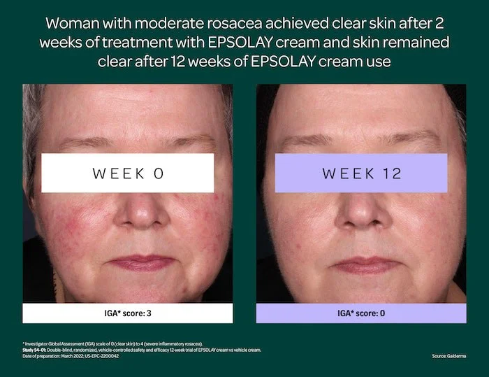 علاج العد الوردي